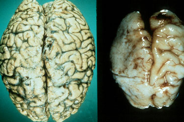 Alkoholom k spätnej fáze vývoja mozgu