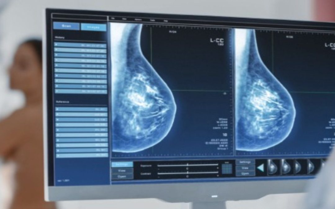 Mamografia je teraz vo Švajčiarsku spochybňovaná