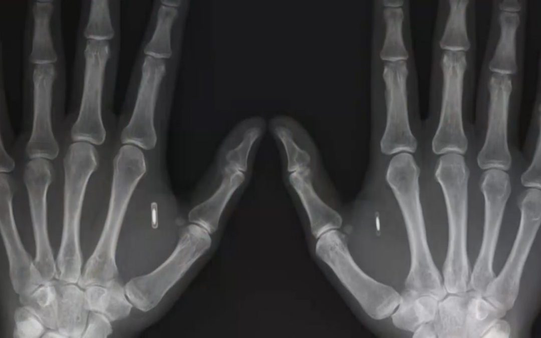 Skrytá história tajného mikročipovania ľudí